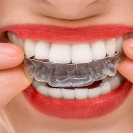 5 Reasons Why Clear Braces Are Right For You